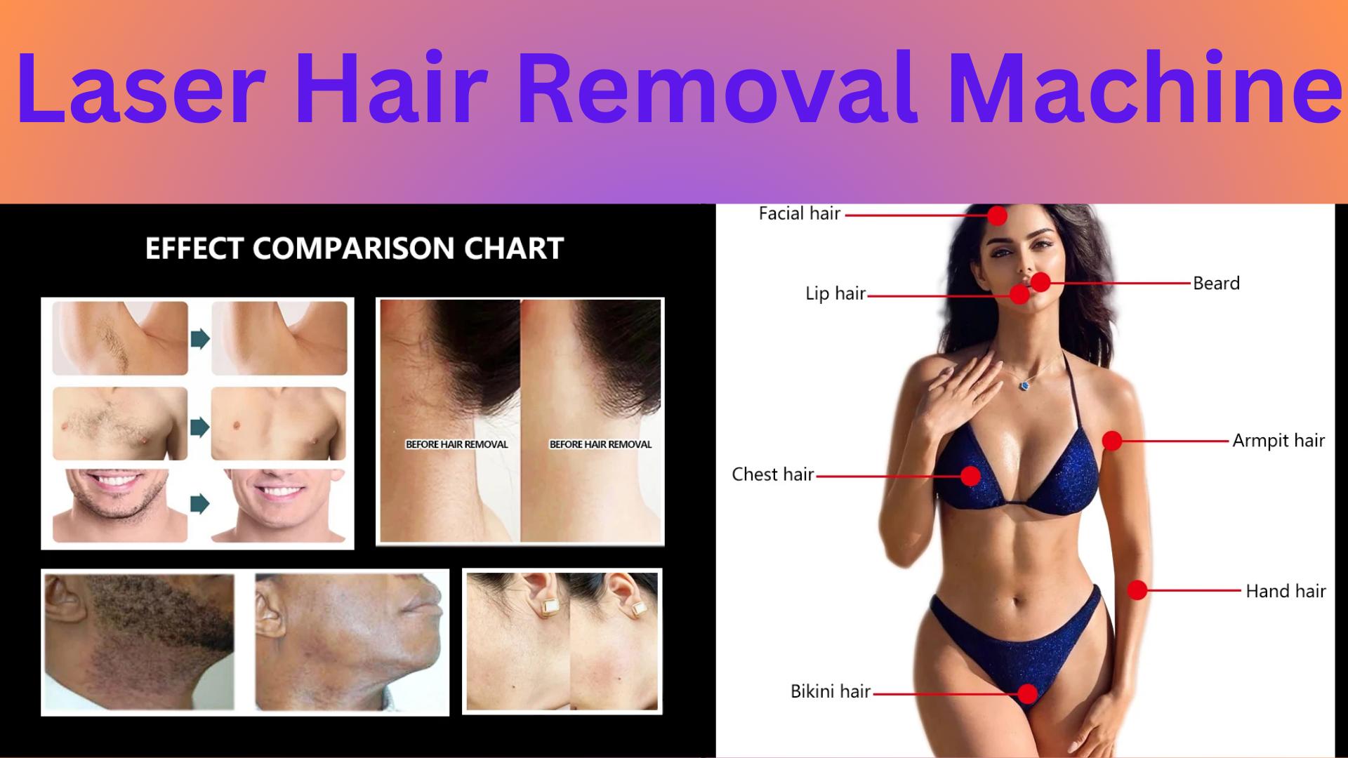  Laser Hair Removal Machine 